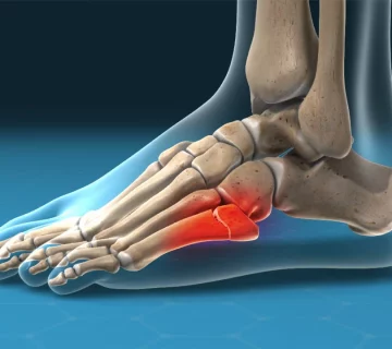 اصابات العظام