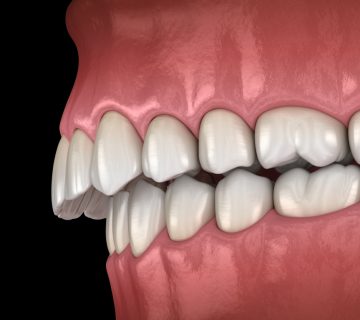 سوء إطباق الأسنان: أنواعه وأسبابه وطرق العلاج
