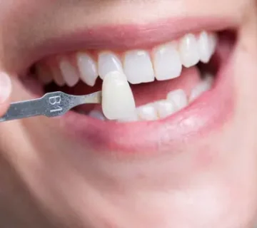 "إرشادات لتركيب الفينير الآمن، الجزء الثاني"