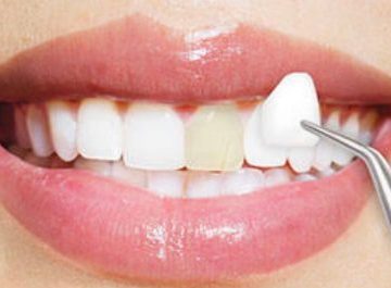 "إرشادات لتركيب الفينير الآمن، الجزء الأول"