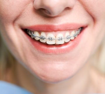 Dental Braces