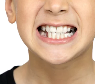 "The Serious Impact of Teeth Grinding on Your Oral Health: What You Need to Know"