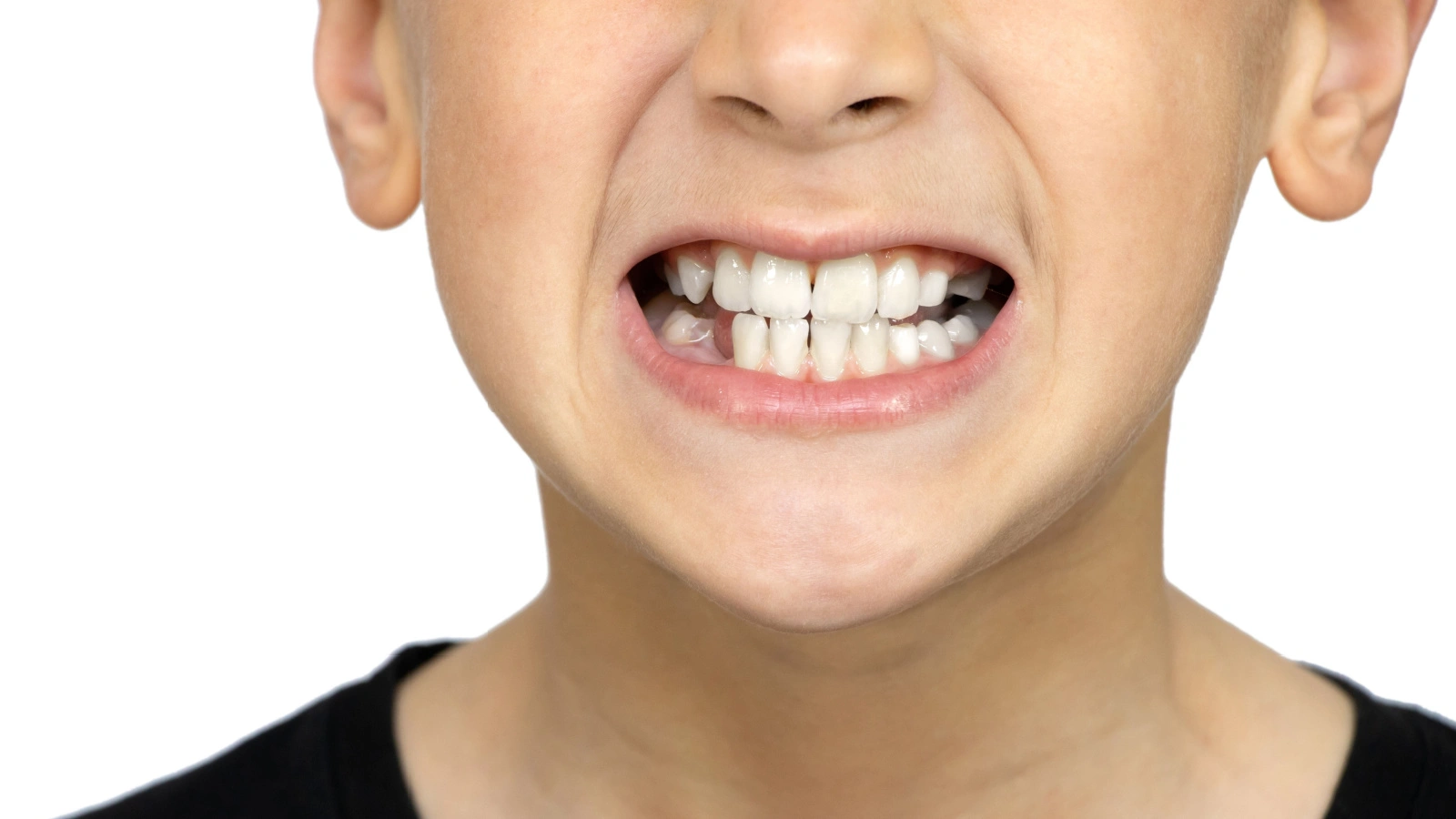 "The Serious Impact of Teeth Grinding on Your Oral Health: What You Need to Know"