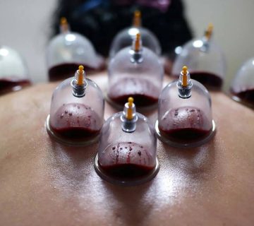 Cupping