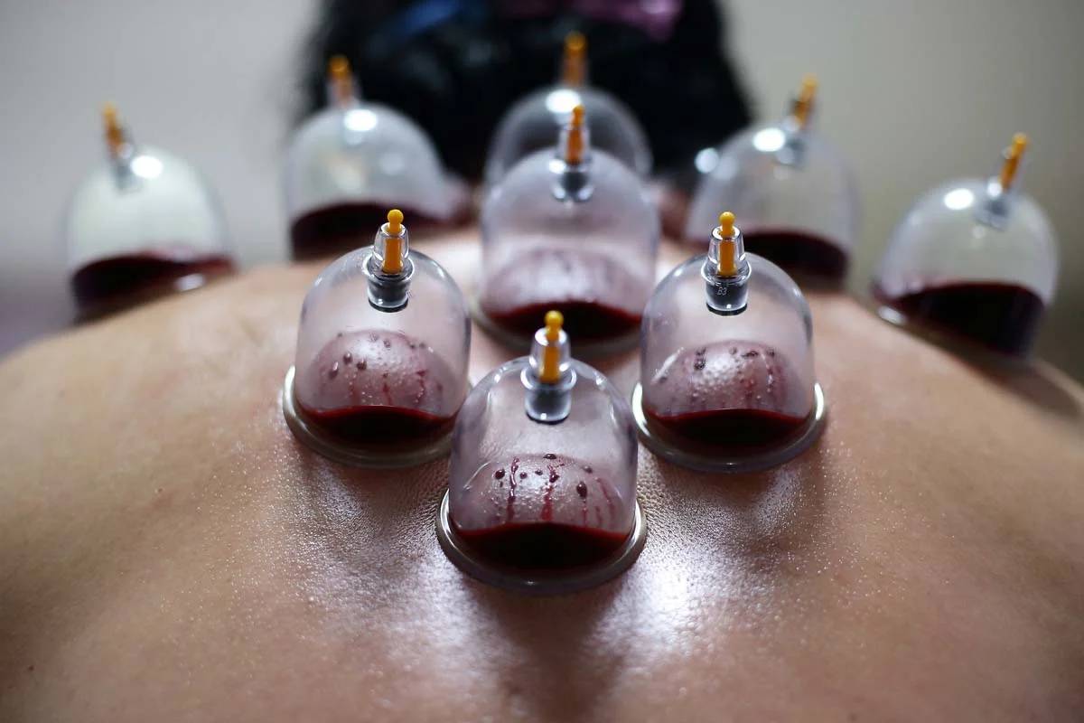 Cupping