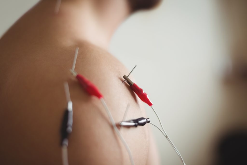 Dry needling is a therapeutic technique that involves inserting thin needles into specific points (often referred to as "trigger points") in the body, with the aim of relieving pain and improving muscle function. It is called "dry" needling to distinguish it from "wet" needling, which involves injecting substances like saline or anesthetics into the body.