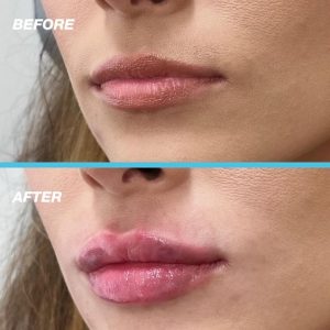 Dissolving the filler is a process typically associated with cosmetic procedures such as dermal fillers. These fillers are substances injected into the skin to enhance facial features or to smooth wrinkles. The most common fillers are made of hyaluronic acid, a substance that naturally occurs in the skin.