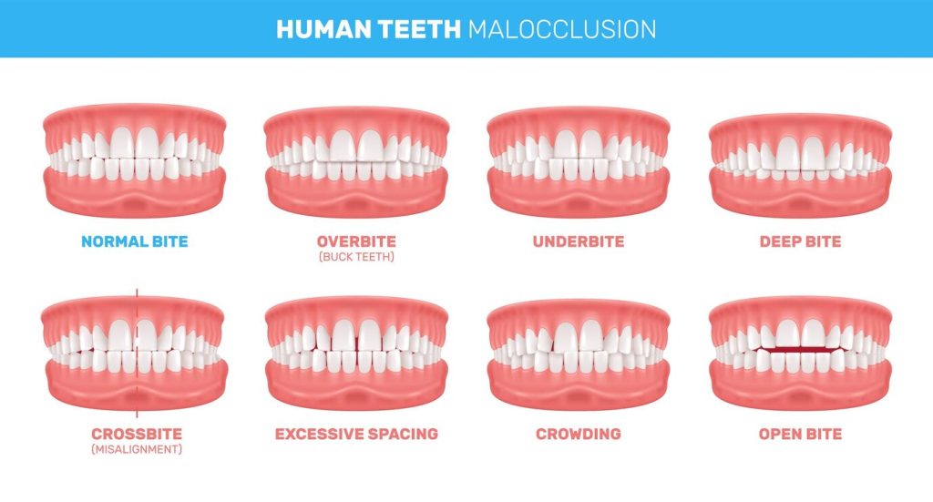 Types of Malocclusion