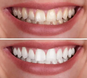 teeth whitening